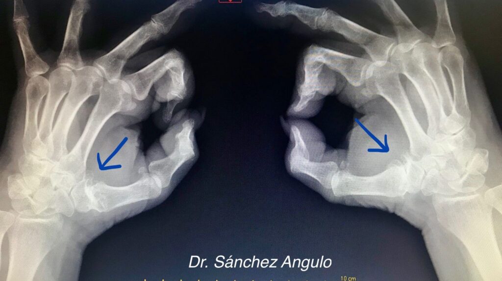 Rayos X Rizartrosis