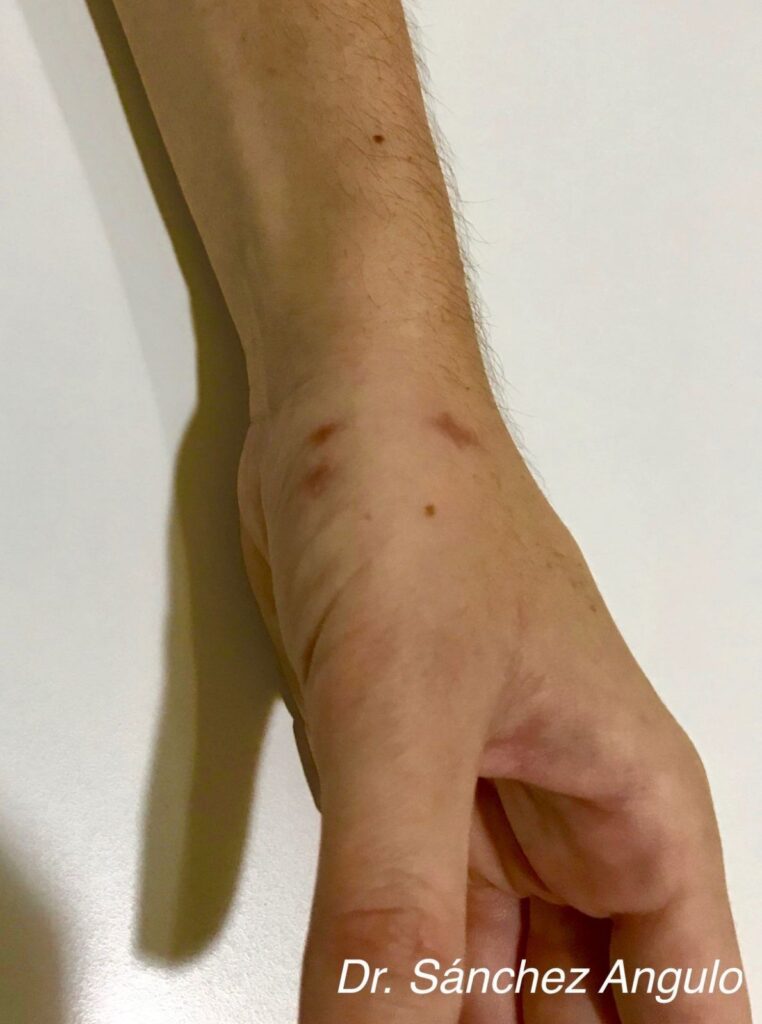 Rizartrosis