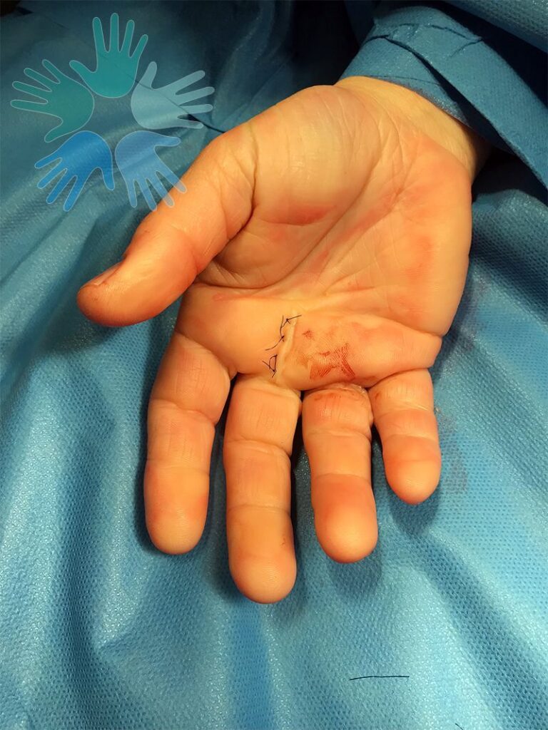 Dr.-Sánchez-Angulo---TENOSINOVITIS-ESTENOSANTE