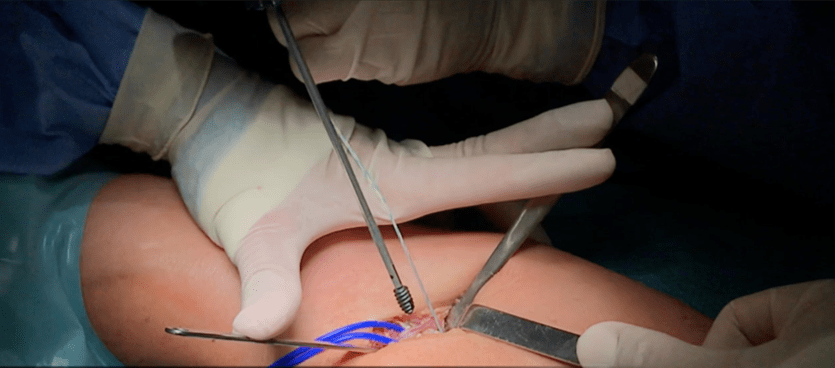 Roturas del tendón distal del bíceps braquial