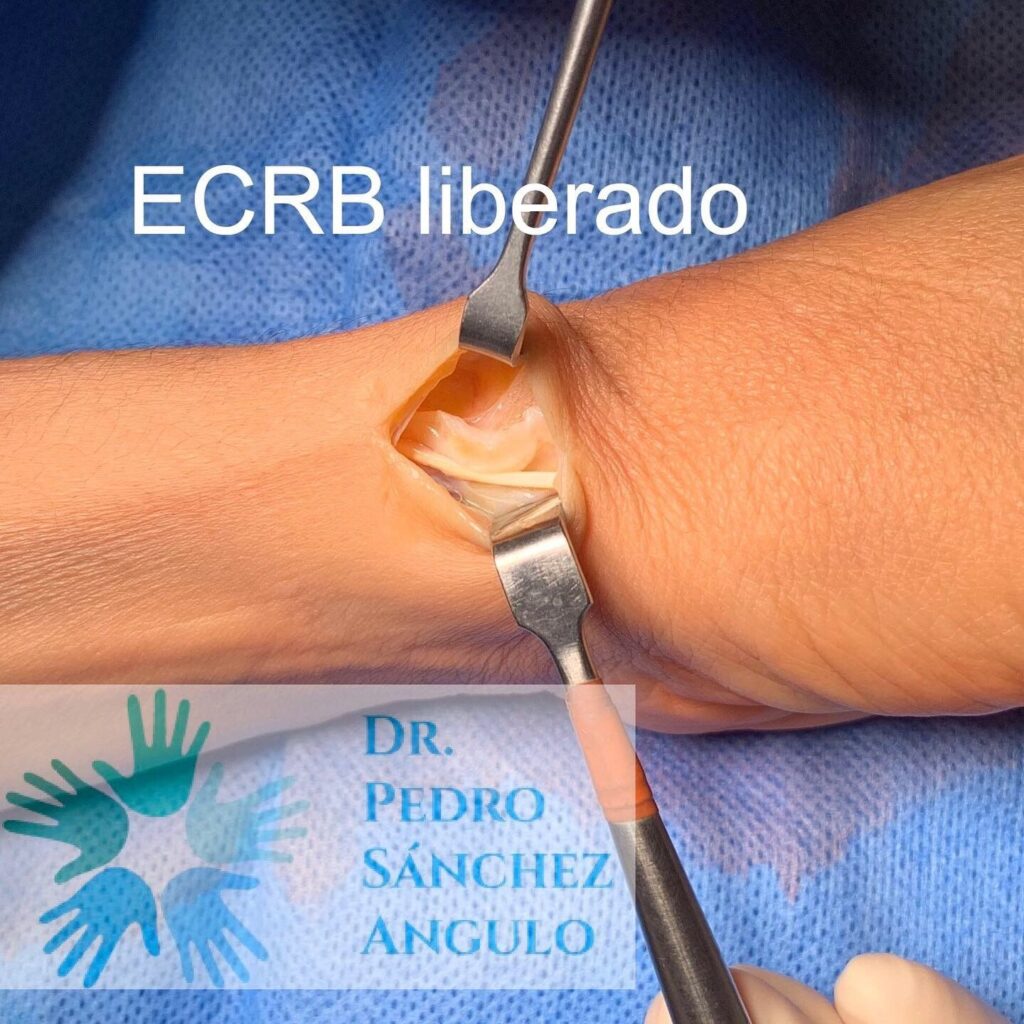 Tenosinovitis Dr. Sánchez Angulo