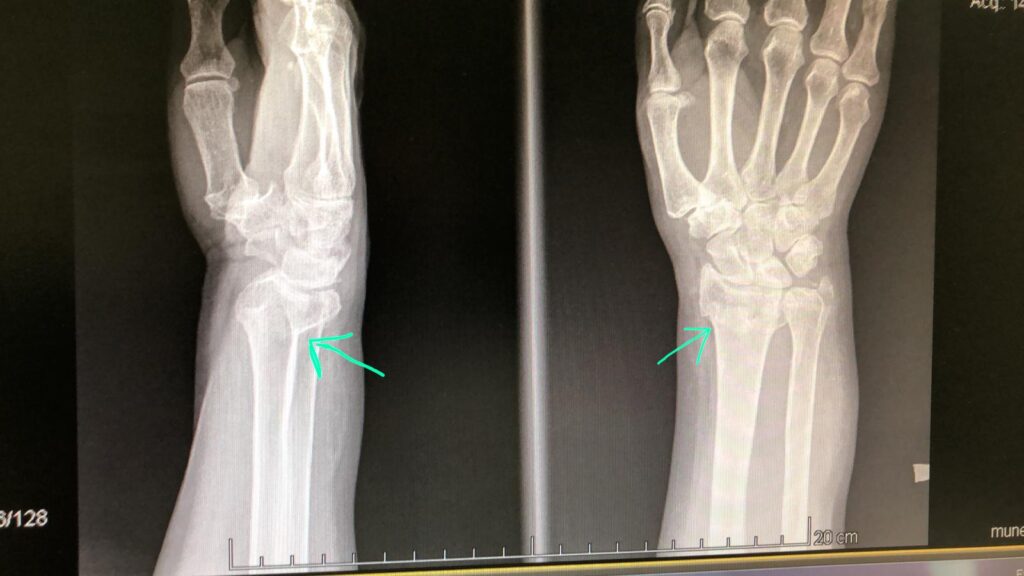 Rx Fractura de Muñeca