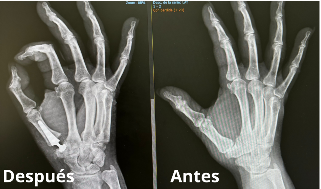 \"Prótesis Prótesis para la artrosis del pulgar