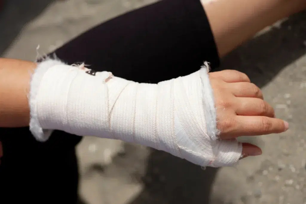 Fotografía de yeso para tiempo de recuperación de una fractura de muñeca